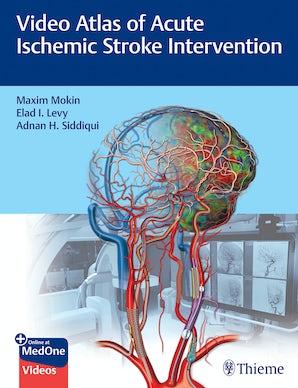 Video Atlas of Acute Ischemic Stroke Intervention