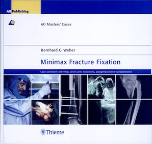 Minimax Fracture Fixation